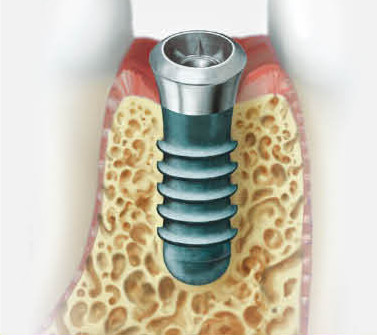 implant-img-3