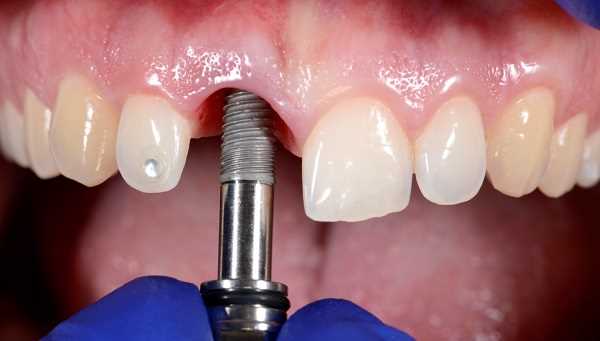 Read more about the article Имплантация одного зуба: процедура, показания и преимущества
