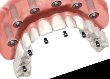 Read more about the article Имплантация зубов all on 6: особенности и преимущества