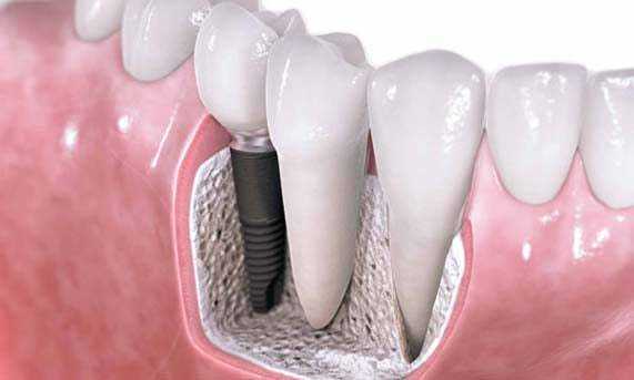 зубы и имплант