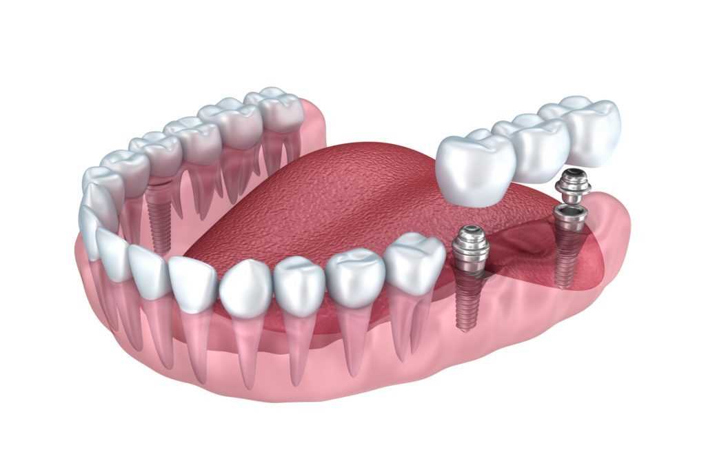 Центр протезирования зубов