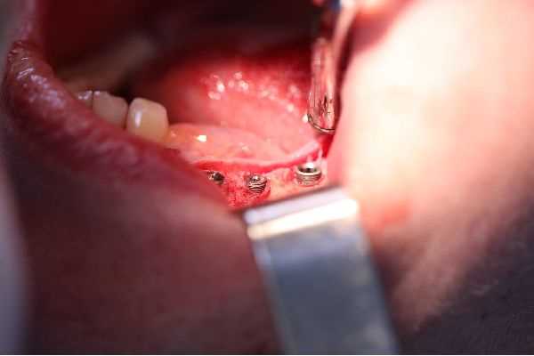 Read more about the article Стоимость имплантации 1 зуба: все, что нужно знать