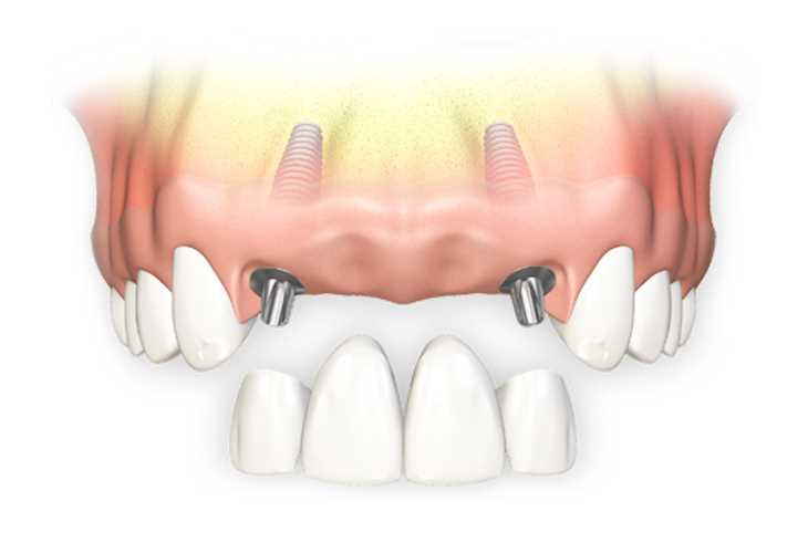 Read more about the article Имплантация передних верхних зубов: все, что вам следует знать