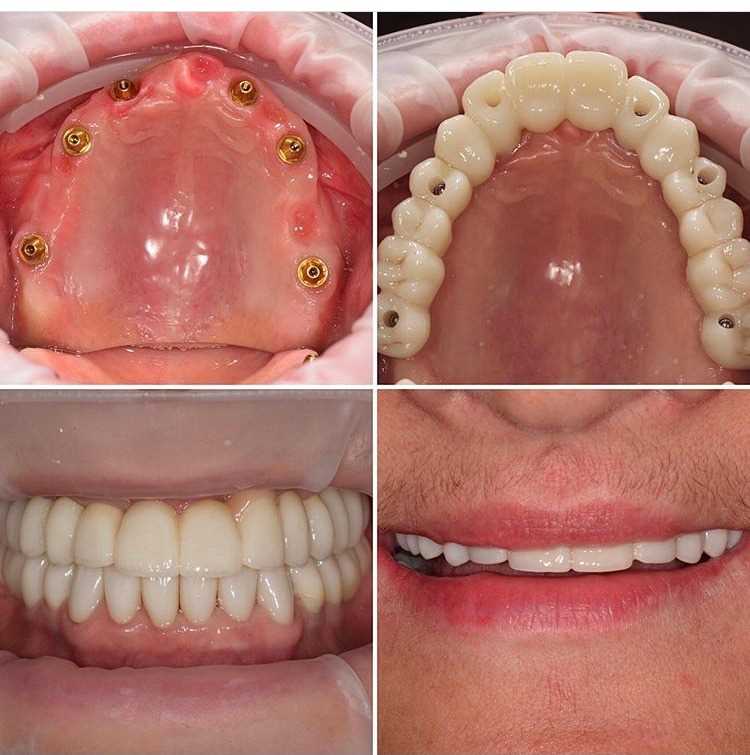 имплантация зубов на 6 имплантах
