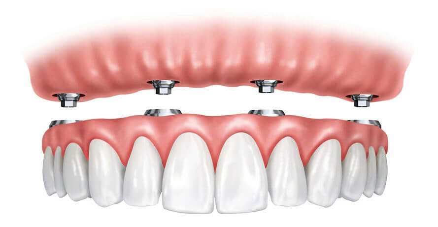 Read more about the article Стоимость имплантации зубов